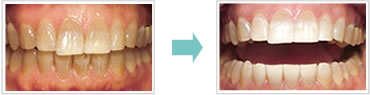 ホワイトニングの症例